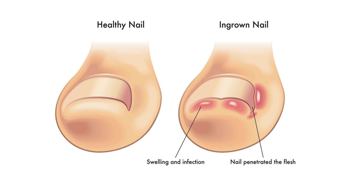 How to Prevent Infection from Your Ingrown Toenai