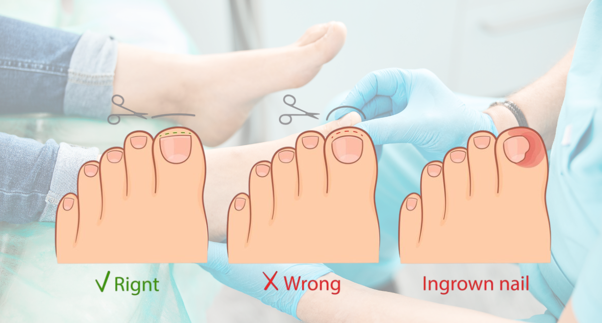 Ingrown Toenail