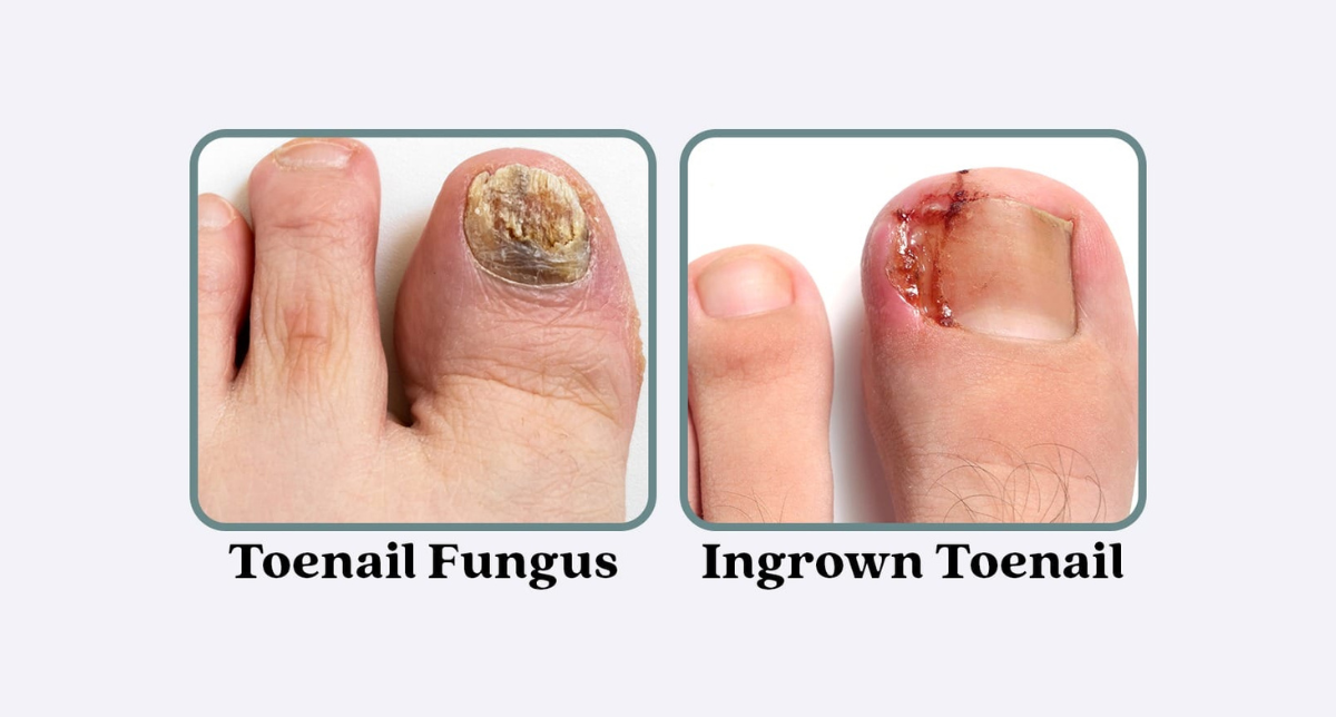 Nail Care and Foot Health: A Podiatrist’s Guide Beyond Ingrown Toenails
