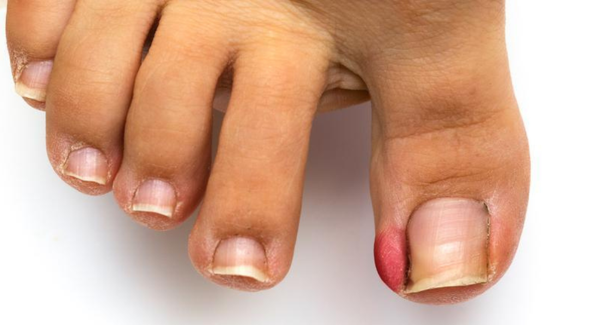 Ingrown Toenail Solutions from Epic Foot & Ankle: Expert Tips.