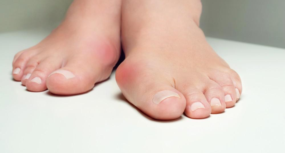 Bunions Begone: How to Fix Bunion Pain Without Compromising Comfort