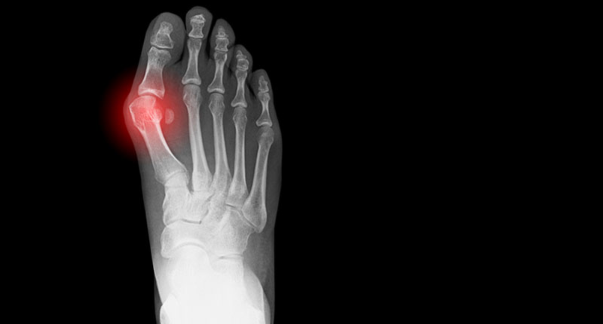 Bunions Making Every Step Painful. Epic Foot and Ankle Provides Effective Treatment Options (1)
