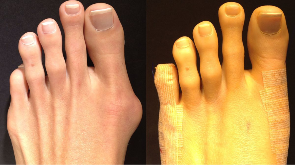 bunions-treatment