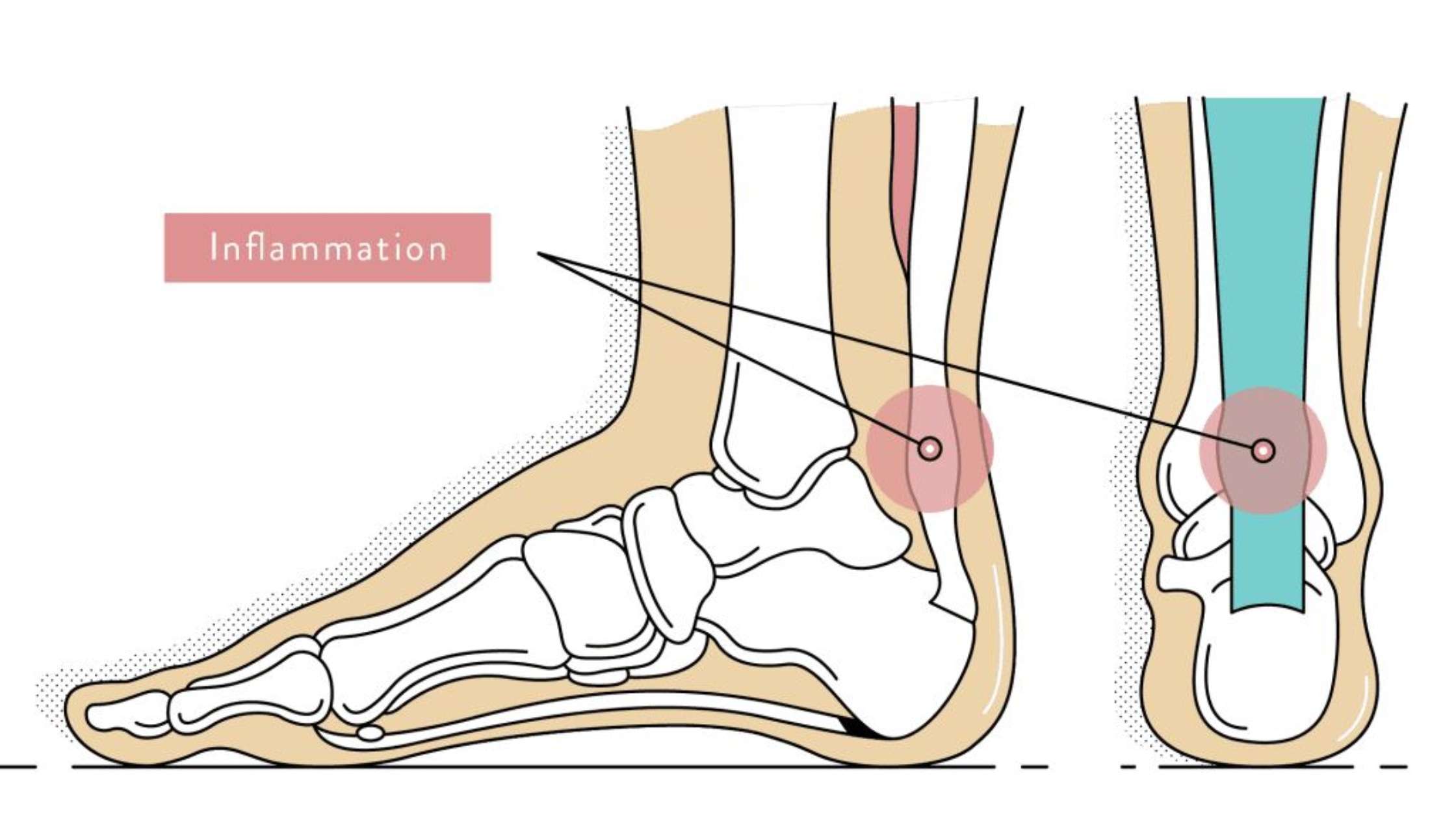 heel-pain