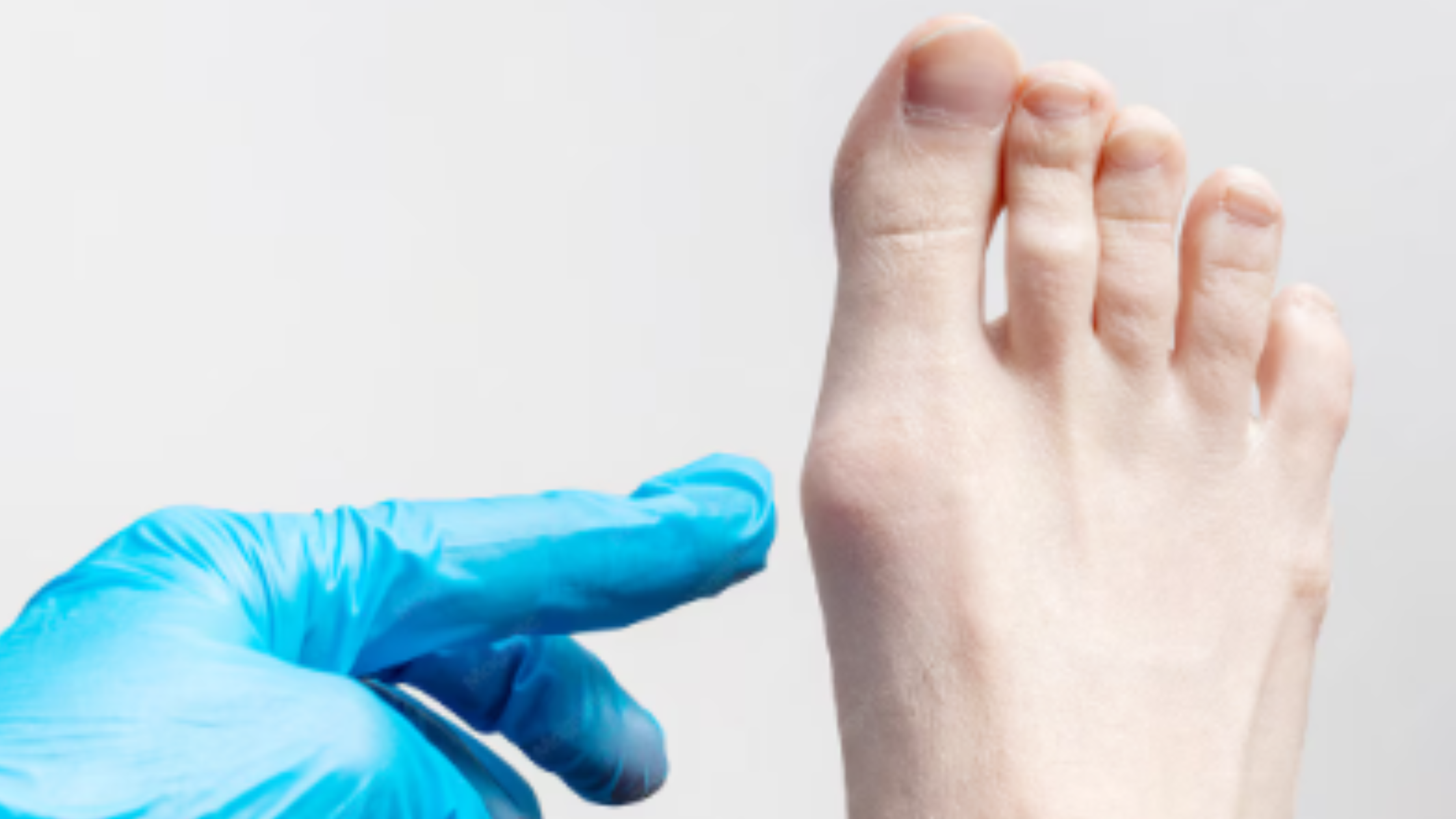 Foot specialist providing bunion treatment in Sugar Land.